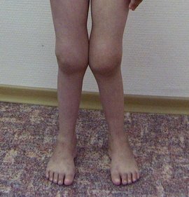 Изменение внешнего вида коленных суставов аллергосептическом варианте ювенильного ревматоидного артрита у детей (фото)
