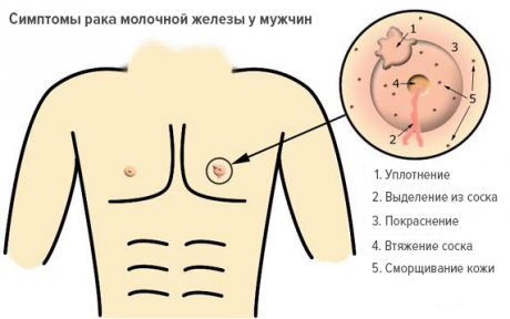 Основные симптомы рака молочной железы у мужчин