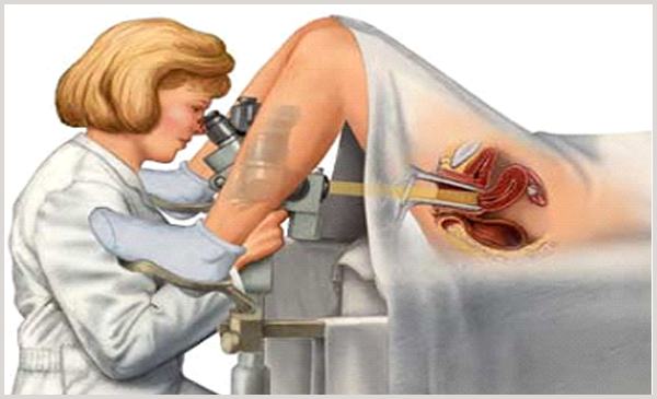 Кольпоскопия - визуальный метод диагностирования эрозии шейки матки